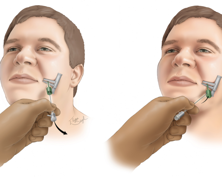 trigeminal-neuralgia-Radiofrequency_Rhizotomy